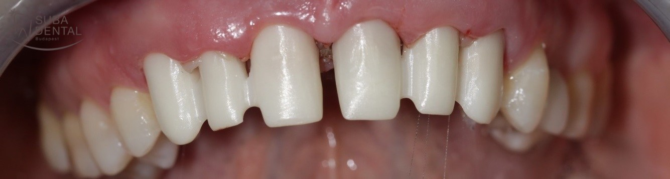 A CAD/CAM technológia használata a fogászatban (100)